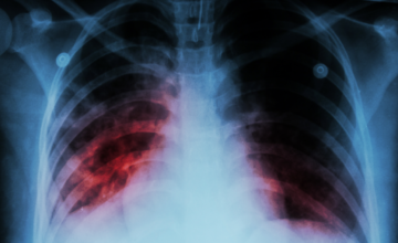 В прошлом году 198 детей и подростков заразились туберкулезом