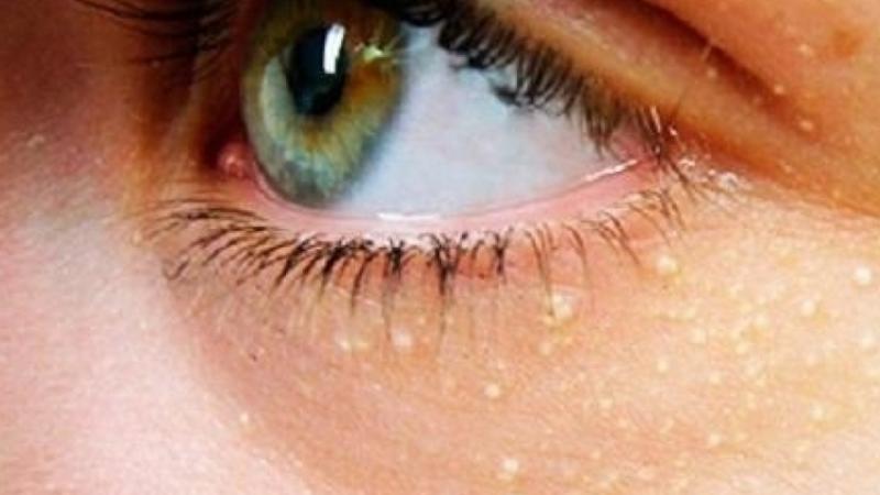Этот признак на лице указывает на риск инфаркта и инсульта