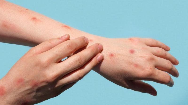 ПОСЛЕДНЯЯ СИТУАЦИЯ С ОСПЕЙ ОБЕЗЬЯН В АЗЕРБАЙДЖАНЕ